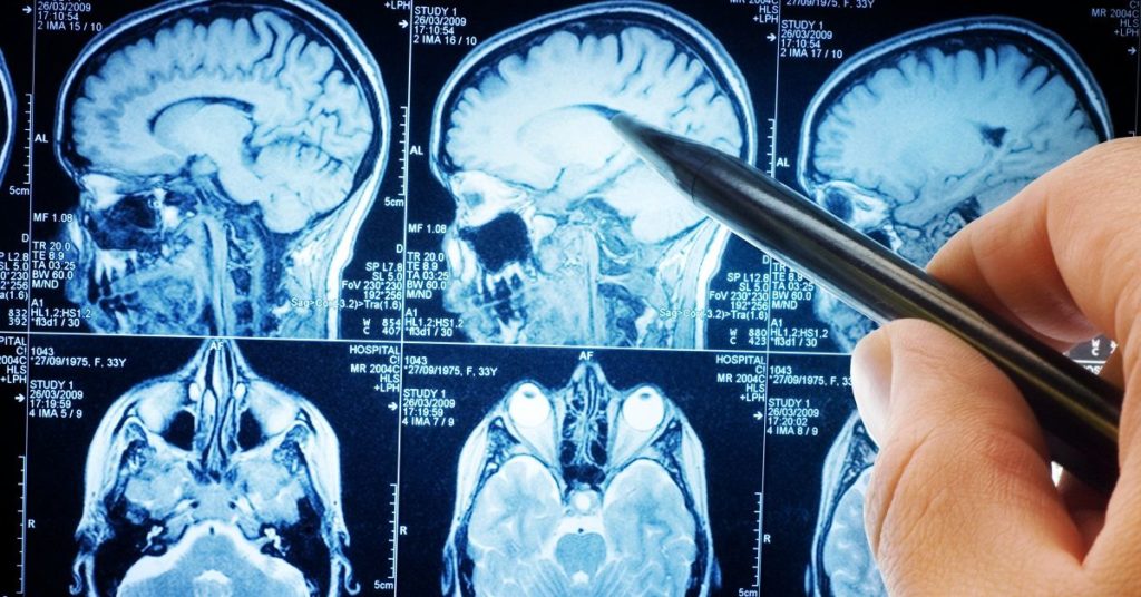 Houston Traumatic Brain Injury Attorneys