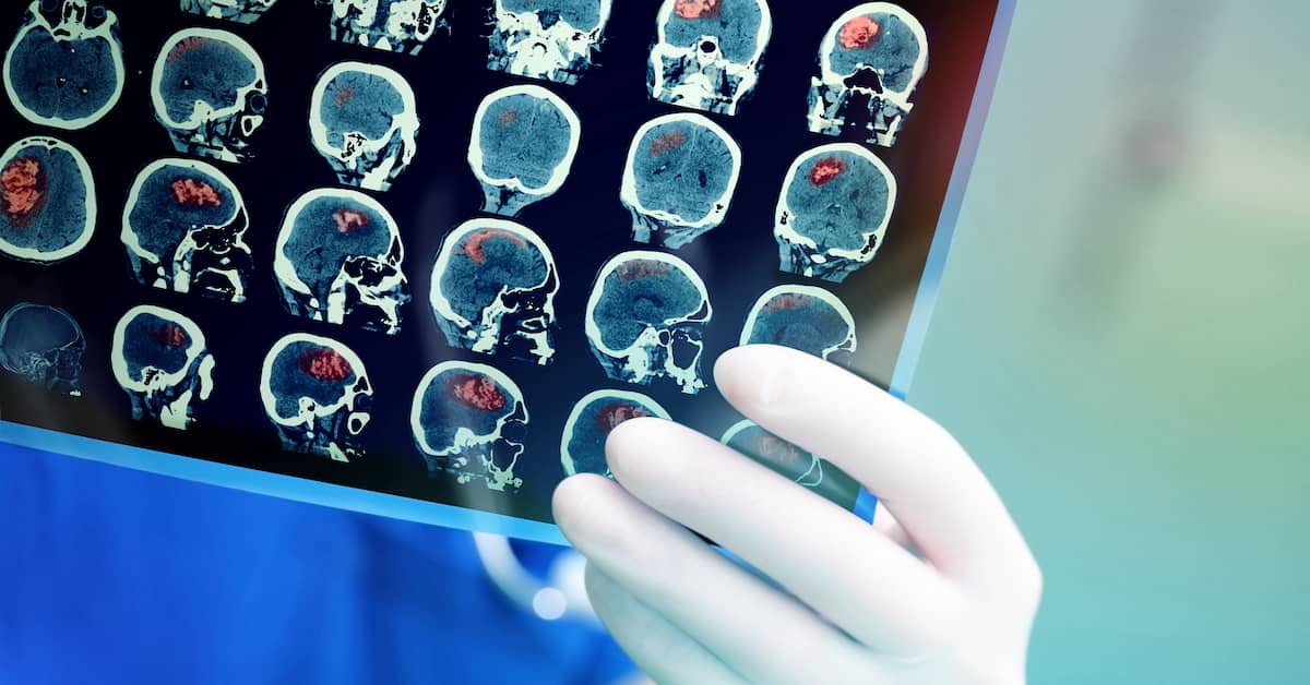 What Is Considered a Catastrophic Injury?